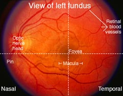 Optic Nerve - Fundoscopy