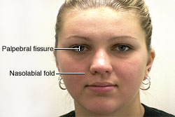 Facial Nerve - Motor