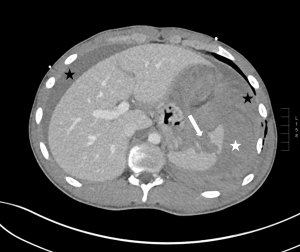 Figure 3. Abdominal CT