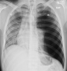 Figure 2. Chest Radiograph