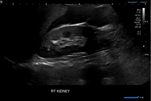 Figure 1. US of RUQ showing interface between kidney and liver