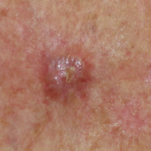 Basal Cell Carcinoma