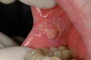 Buccal Squamous Cell Carcinoma