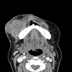 Buccal Squamous Cell Carcinoma Radiograph