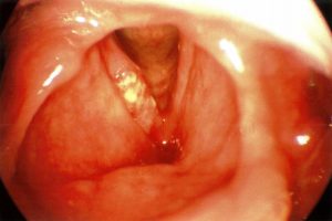 Laryngeal Squamous Cell Carcinoma