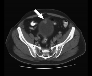 Computed tomography (CT) scan of the bladder showing bladder carcinoma (arrow).