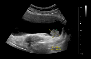 Ultrasound scan showing a tumor on the back wall of the bladder.