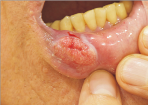 Lip Squamous Cell Carcinoma