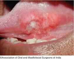 Oral Squamous Cell Carcinoma