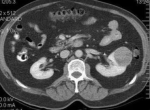 Renal Cell Carcinoma